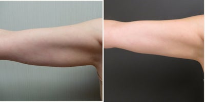 Arm Lift before and after photo