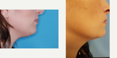 Kybella before and after photo