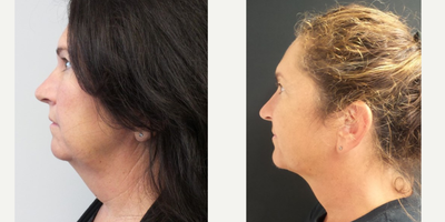 Kybella before and after photo