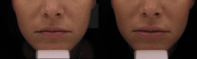 Belotero before and after photo
