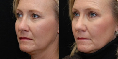Eyelid Surgery before and after photo