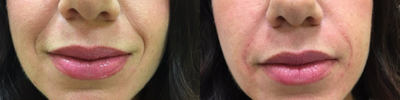Juvederm before and after photo