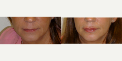 Lip Fillers before and after photo