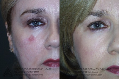Mohs Surgery before and after photo