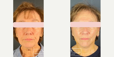 Skin Tightening before and after photo