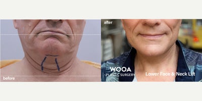Facelift before and after photo