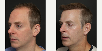 Hair Transplant before and after photo