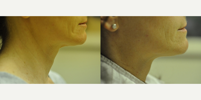 TriPollar before and after photo