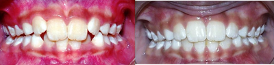 Braces before and after photo