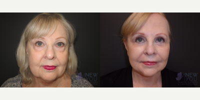 Facelift before and after photo