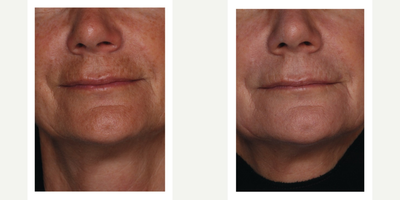 Fraxel Laser before and after photo