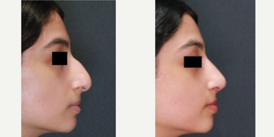 Septoplasty before and after photo