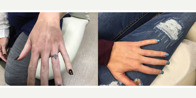 Tattoo Removal before and after photo