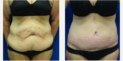 Tummy Tuck before and after photo