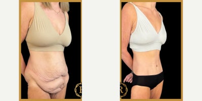 Breast Lift with Implants before and after photo