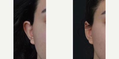 Ear Surgery before and after photo