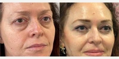 Eyelid Surgery before and after photo