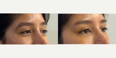 Eyelid Surgery before and after photo