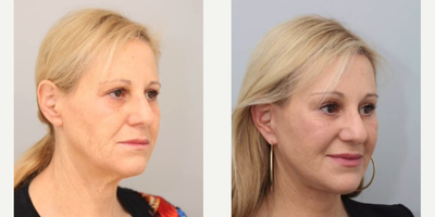 Facelift before and after photo