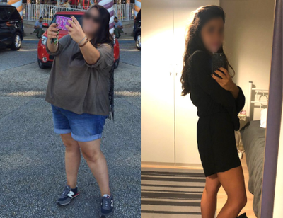 Gastric Sleeve Surgery before and after photo