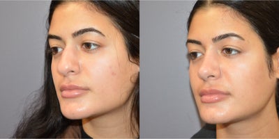 Rhinoplasty before and after photo