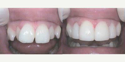 Smile Makeover before and after photo