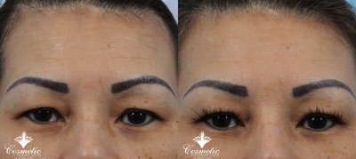 Botox before and after photo