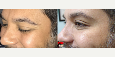 Botox before and after photo
