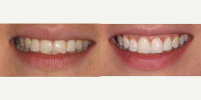Dental Bonding before and after photo