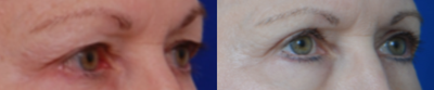Eyelid Surgery before and after photo