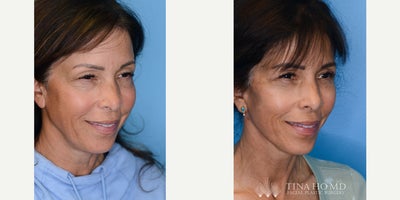 Brow Lift before and after photo