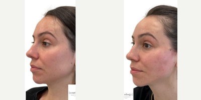 Chin Filler before and after photo