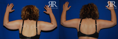 Arm Lift before and after photo