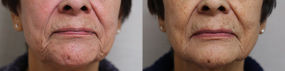 Bellafill before and after photo