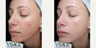 Chemical Peel before and after photo