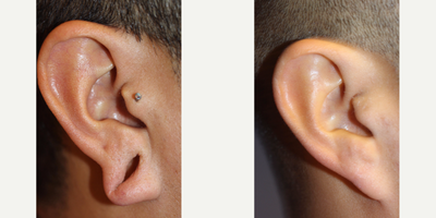 Earlobe Repair before and after photo