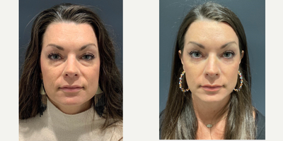 Eyelid Surgery before and after photo