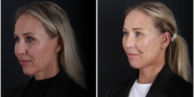 Facelift before and after photo