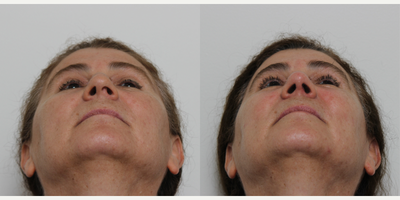 Rhinoplasty before and after photo