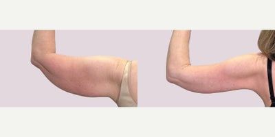 Arm Lift before and after photo