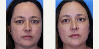 Botox before and after photo