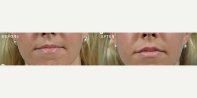 Botox before and after photo