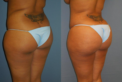 Butt Augmentation before and after photo