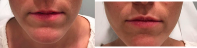 Juvederm before and after photo
