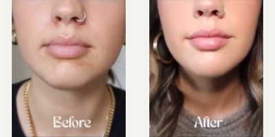 Restylane Lyft before and after photo
