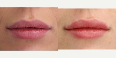 Restylane Refyne before and after photo