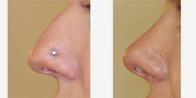 Rhinoplasty before and after photo