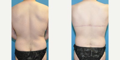 Body Lift before and after photo