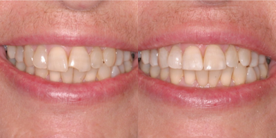 Dental Bonding before and after photo
