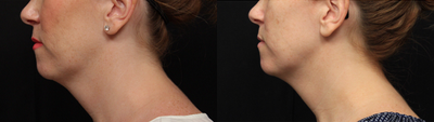 Kybella before and after photo
